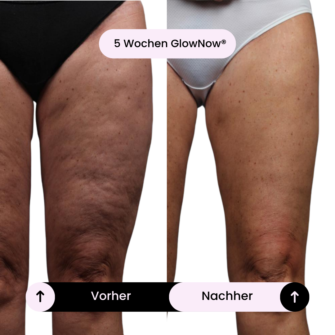 GlowNow® Anti-Cellulite Duo
