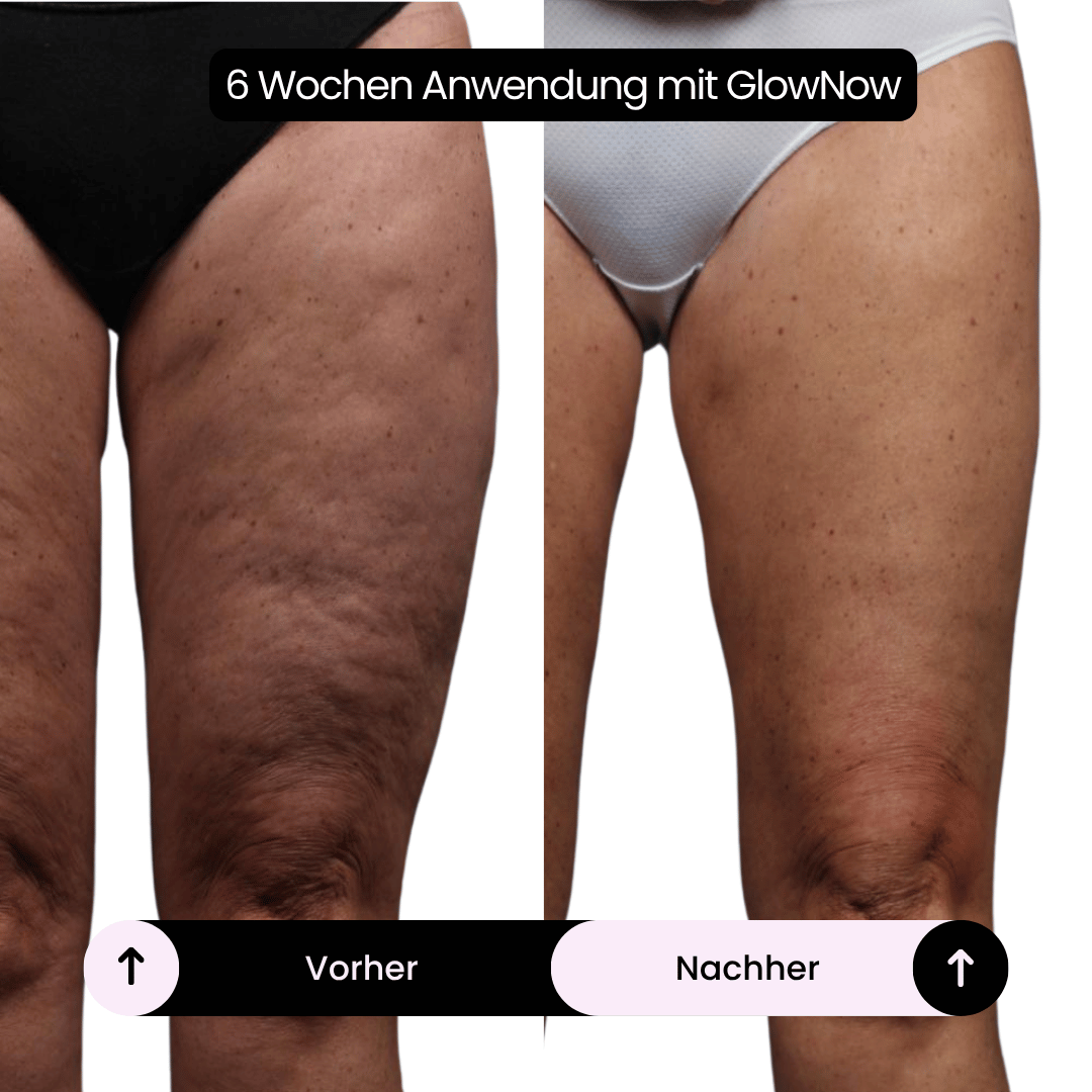 GlowNow Cellulite-Massagegerät™