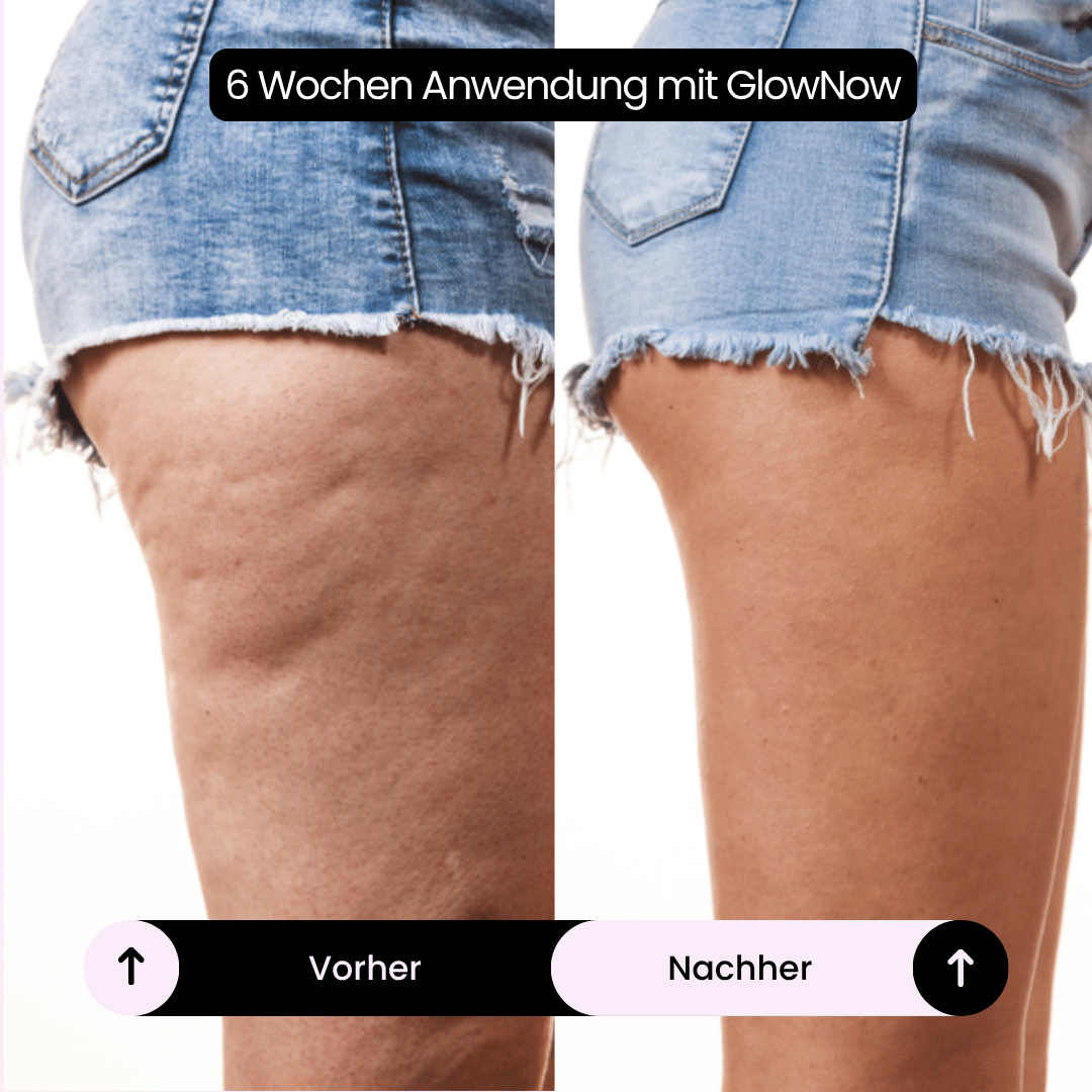 GlowNow Cellulite-Massagegerät™