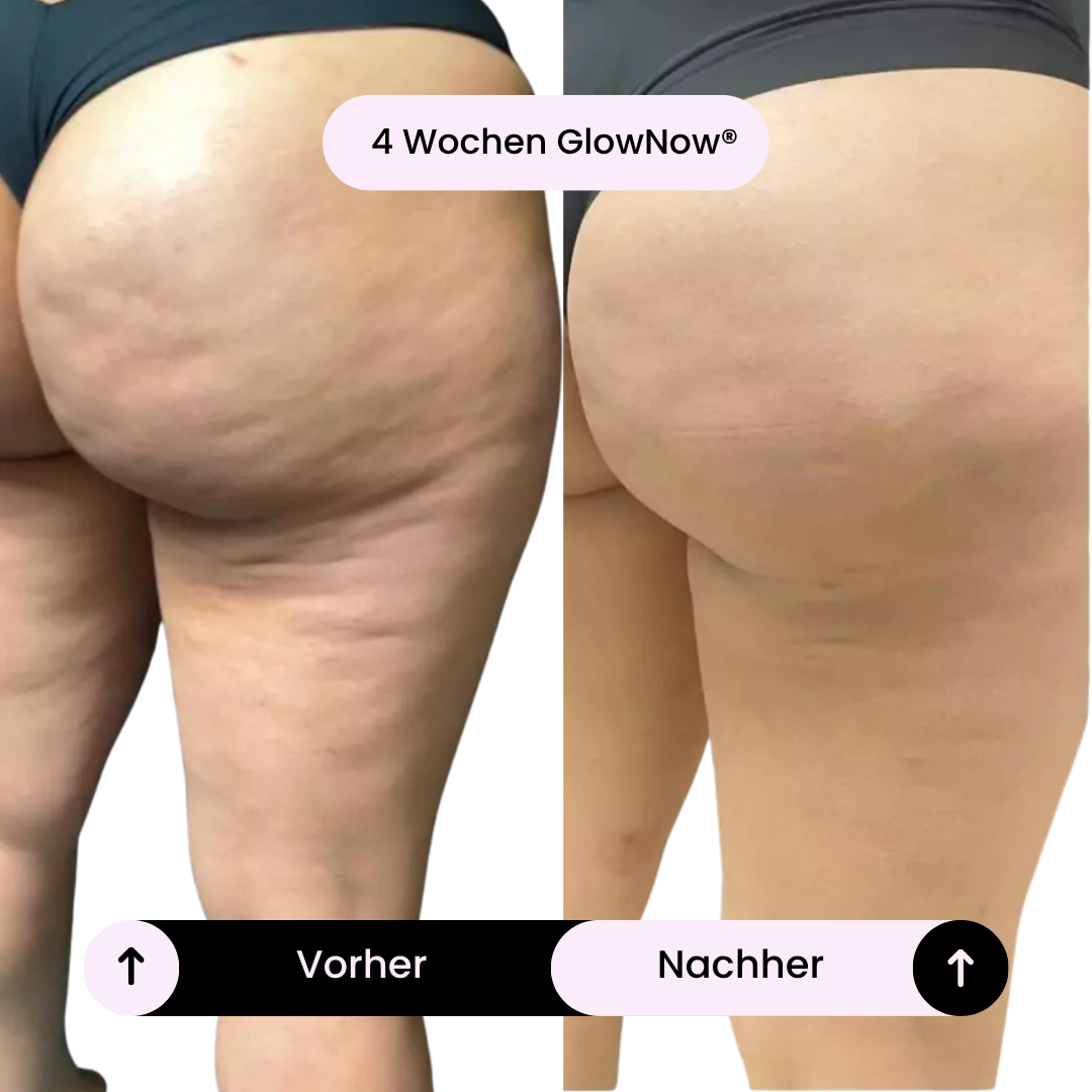 GlowNow Cellulite-Massagegerät™