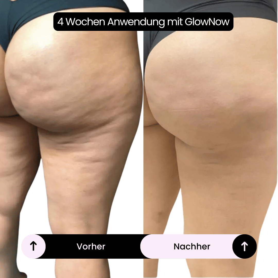 GlowNow Cellulite-Massagegerät™